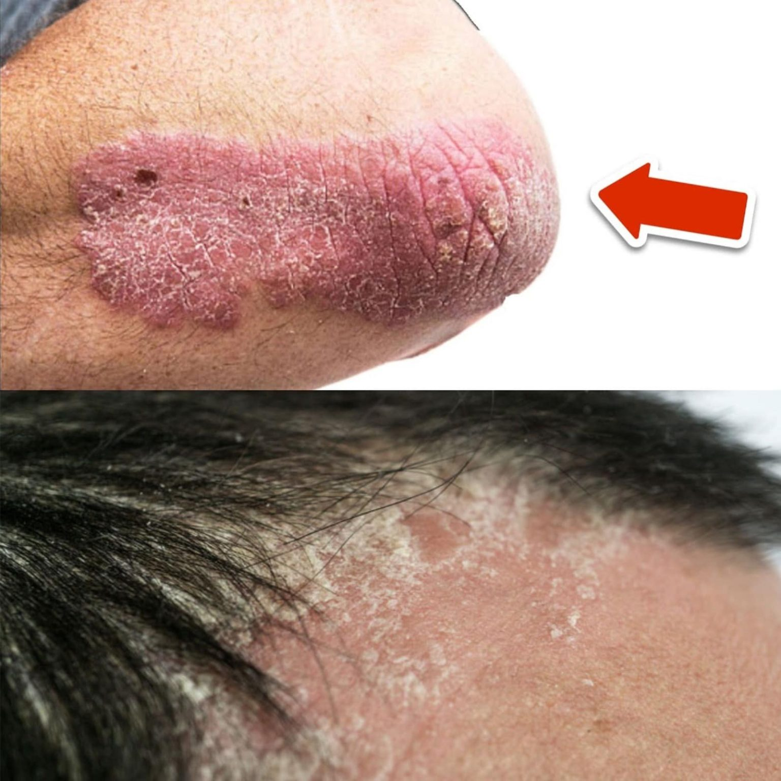 This Vitamin Can Get Rid of Psoriasis Permanently (INCREDIBLE)