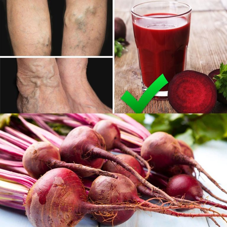 Drink This Juice to Prevent and Treat Varicose Veins